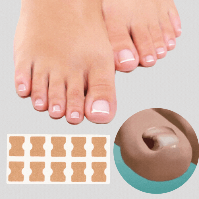 Patchs correcteurs d'ongles incarnés indolores pour hommes et femmes, soin efficace des pieds.