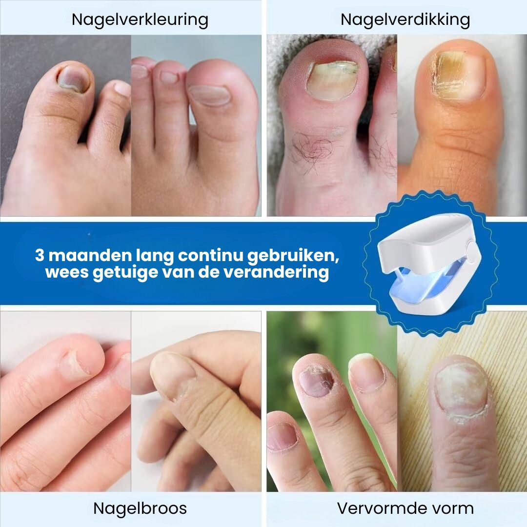 Traitement ongle Dermanail: une solution rapide pour éradiquer les mycoses.
