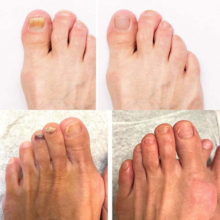 Dermanail, soin puissant anti-champignon pour des ongles des pieds et mains sains.