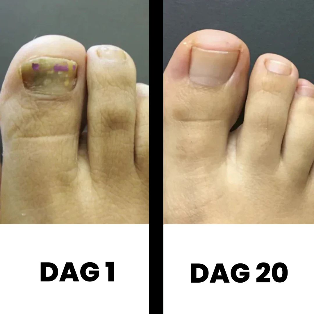 Flacon de traitement Dermanail, votre allié contre la mycose des ongles.