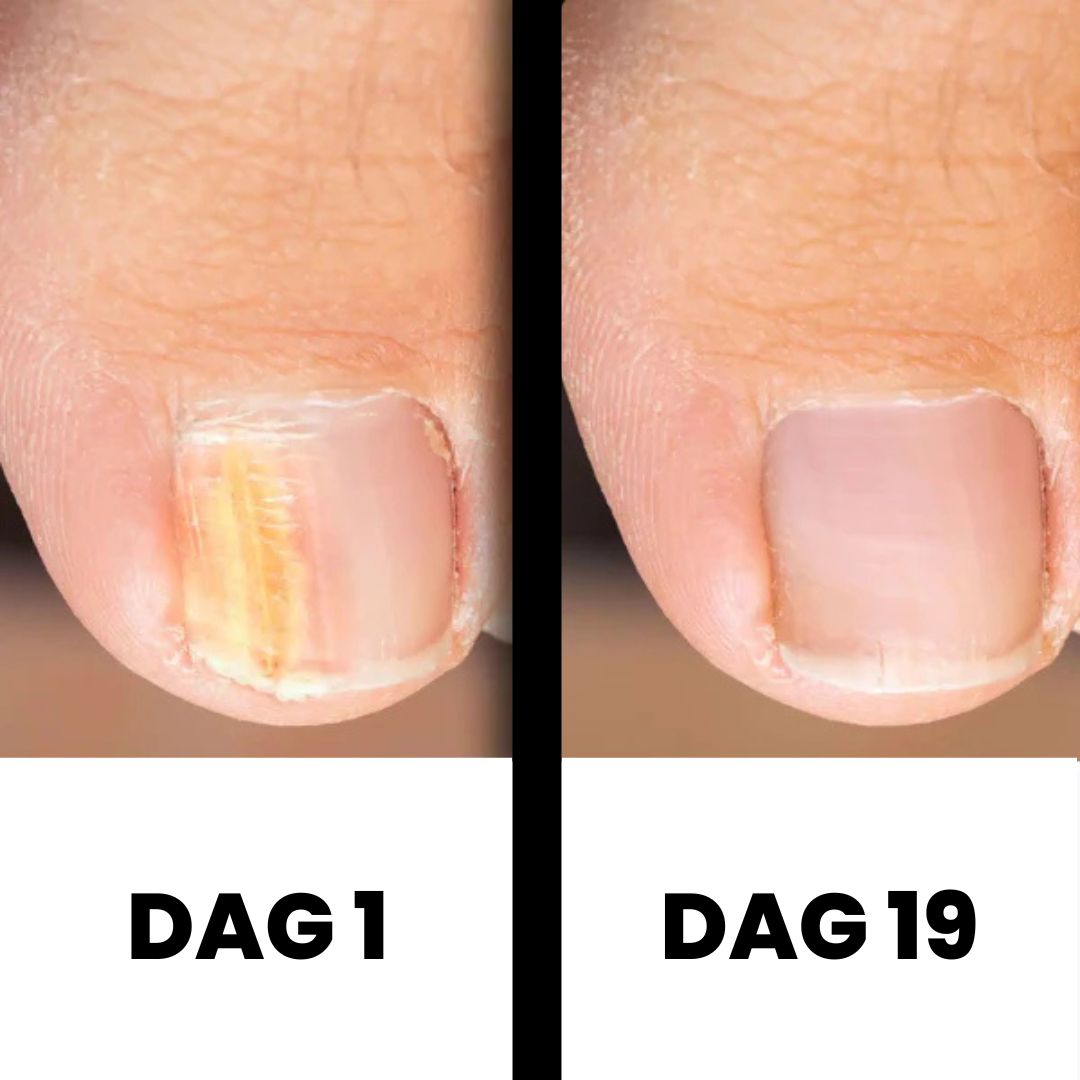 Soin Dermanail pour les mycoses des ongles, restaure la santé de l'ongle.