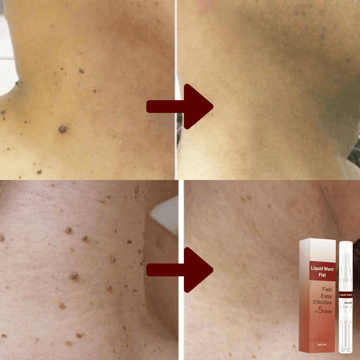 Traitement naturel pour les imperfections cutanées : verrues, taches, grains. Pour une peau saine et belle.