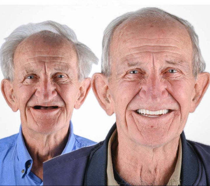 Prothèses temporaires auto-ajustables pour un sourire immédiat, confort et facilité d'adaptation.