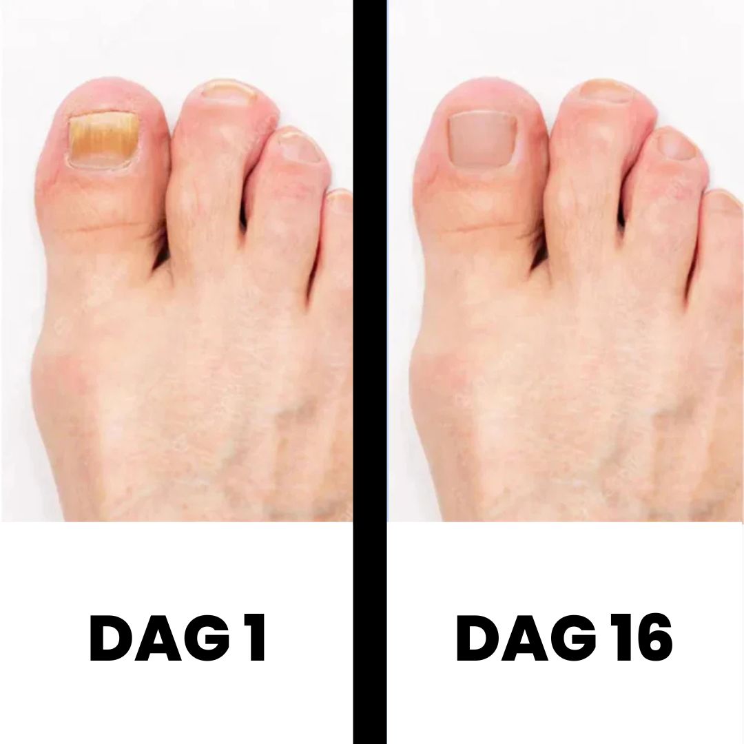 Dermanail: l'efficacité prouvée pour des ongles beaux et sans mycose.