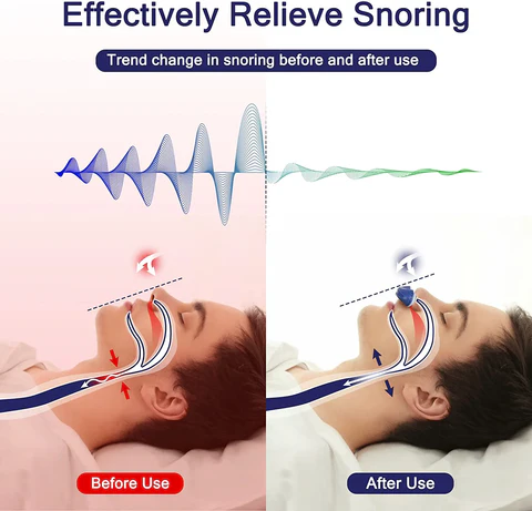 Aide nasale anti-ronflement compacte et silencieuse. Offre un confort optimal pour une respiration aisée et un sommeil paisible.