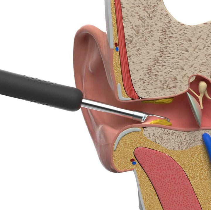 Solution intelligente pour cérumen : nettoyeur d'oreilles avec caméra HD, sûre et efficace pour la santé auditive.