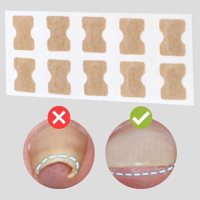 Application d'un patch correcteur transparent sur un ongle incarné pour une pédicure saine.