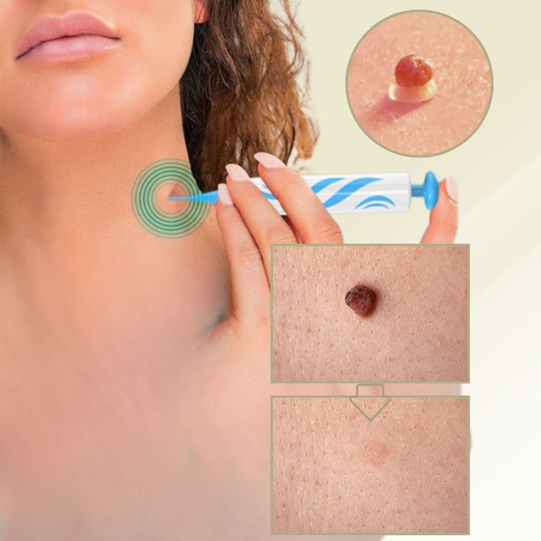 Outil DermaLinx pour l'élimination indolore des verrues et grains de beauté à domicile. Kit soin peau.