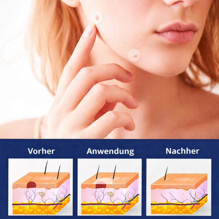 Soin anti-imperfection dermatologique : patchs discrets pour mollettes et étiquettes cutanées. Beauté de la peau.