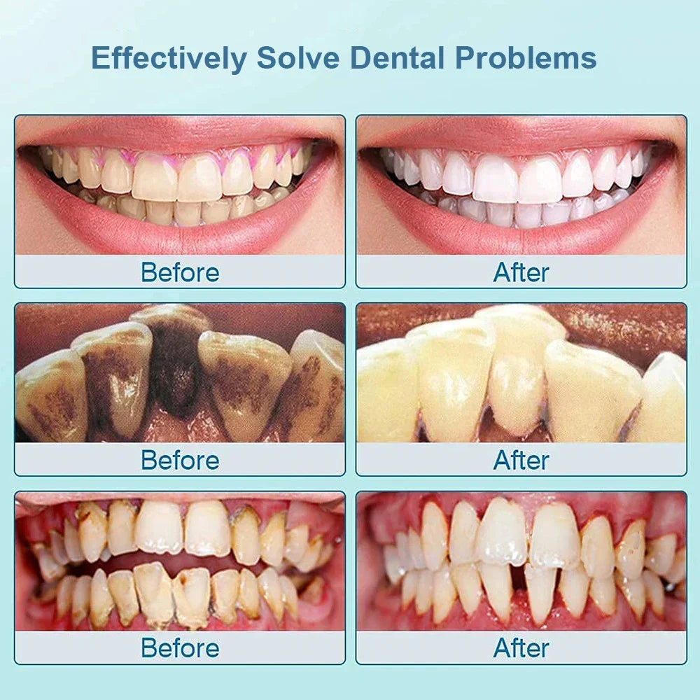 Coffret complet de brosse à dents ultrasonique, solution pour hygiène buccale, anti-tartre et sourire éclatant.