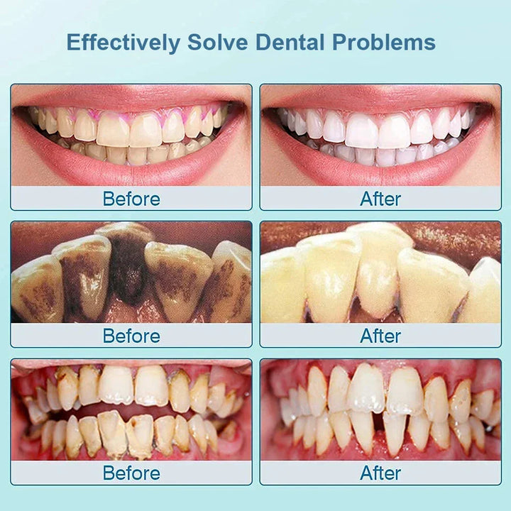 Coffret complet de brosse à dents ultrasonique, solution pour hygiène buccale, anti-tartre et sourire éclatant.