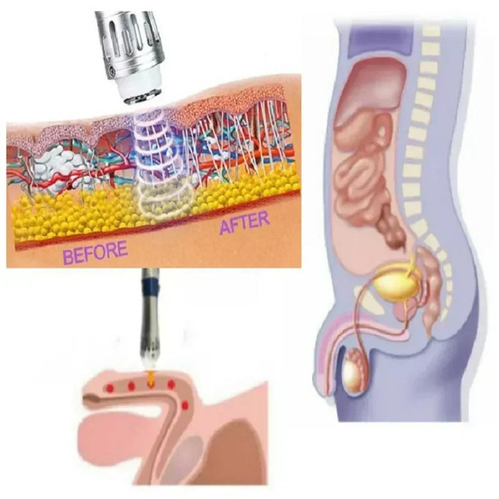 Dispositif portable de thérapie par onde de choc pour la dysfonction érectile et récupération musculaire.