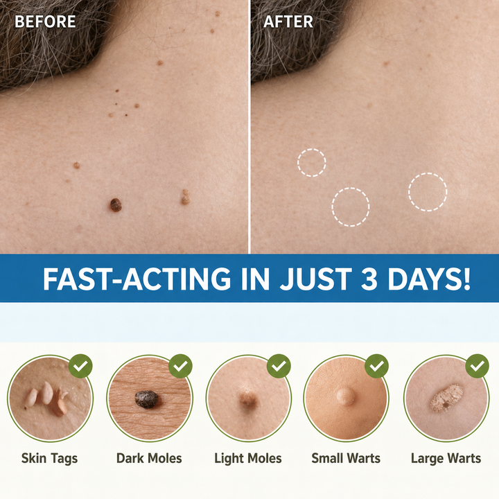 Solution naturelle et sûre: ces patchs éliminent les acrochordons sans douleur. Pour une peau nette et saine.