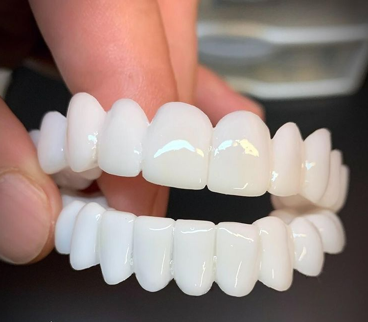 Facettes dentaires unisexe pour un sourire parfait et naturel, améliorant l'esthétique.