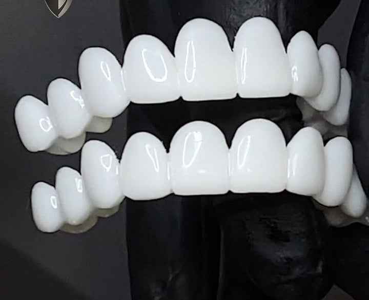 Facettes dentaires d'aspect naturel pour une beauté dentaire instantanée et un sourire impeccable.