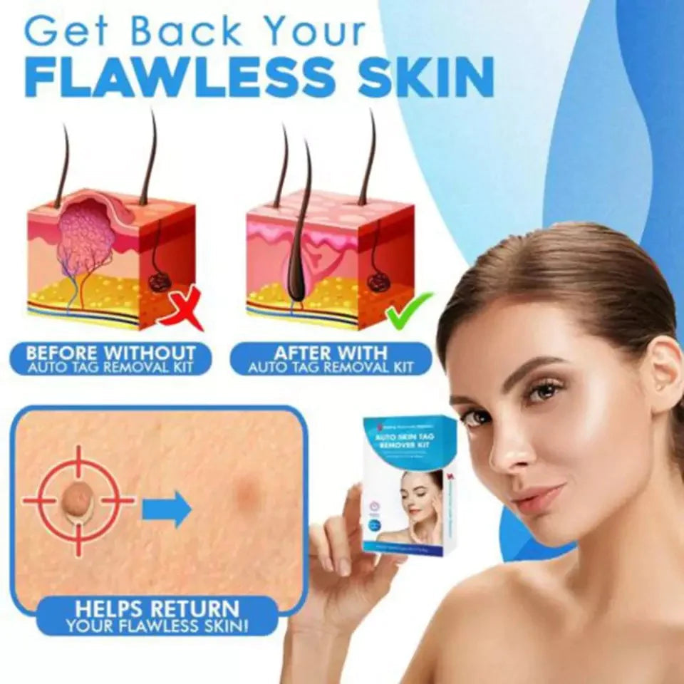 Kit beauté pour une peau nette : élimination des acrochordons par applicateur d'élastiques.