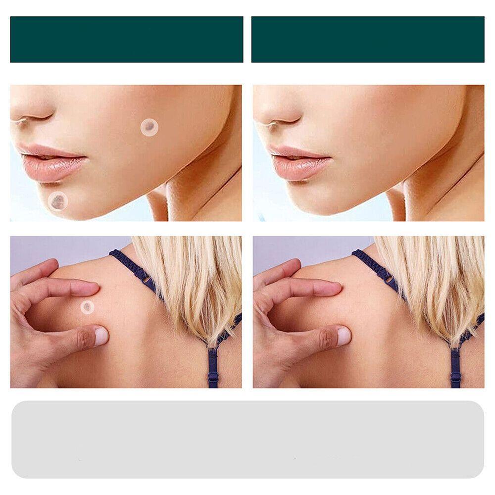 Patchs innovants pour l'élimination ciblée des verrues et taches. Solution discrète et douce pour la peau sans imperfections.