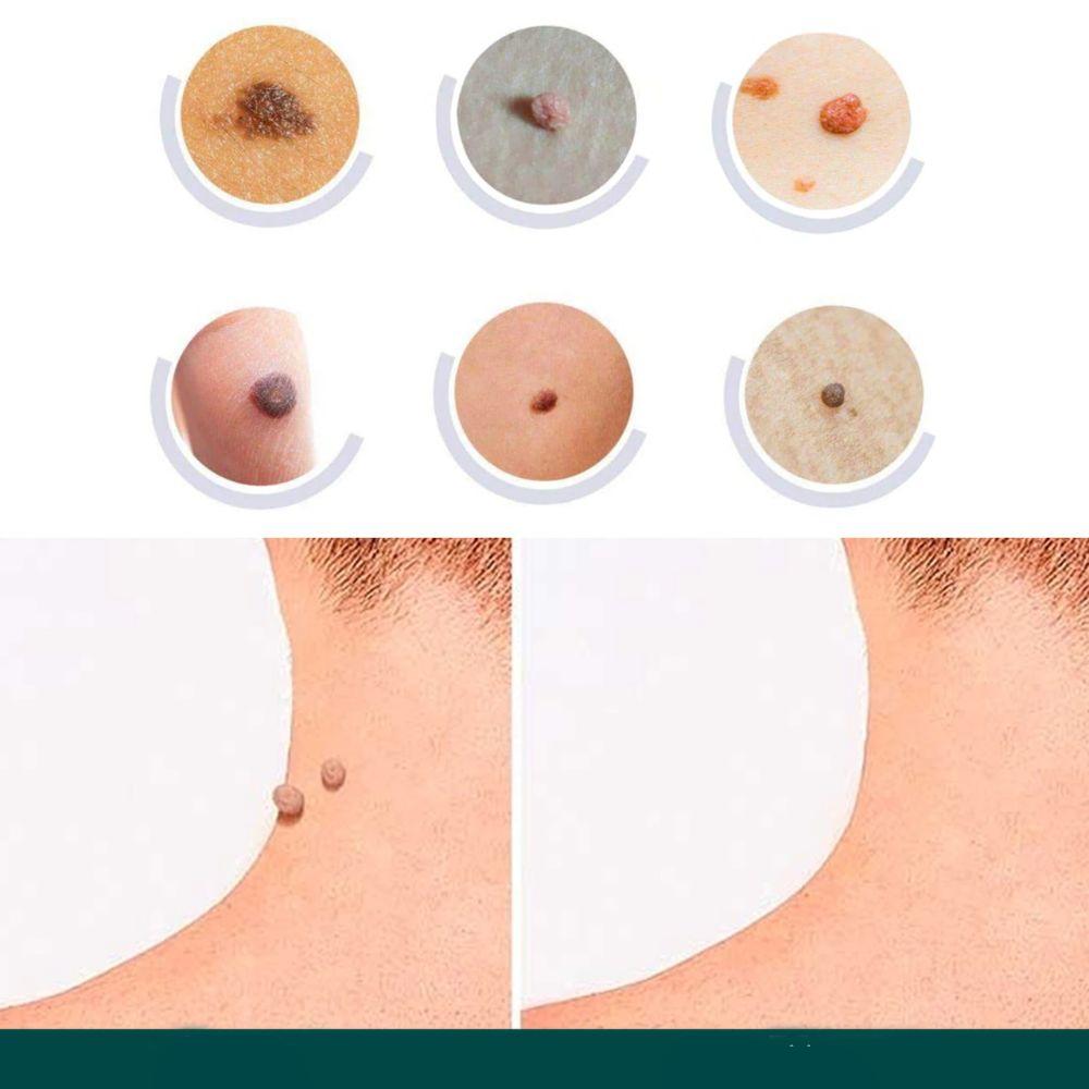 Dites adieu aux verrues et taches ! Patchs dermatologiques efficaces pour une peau lisse, claire et sans imperfections.