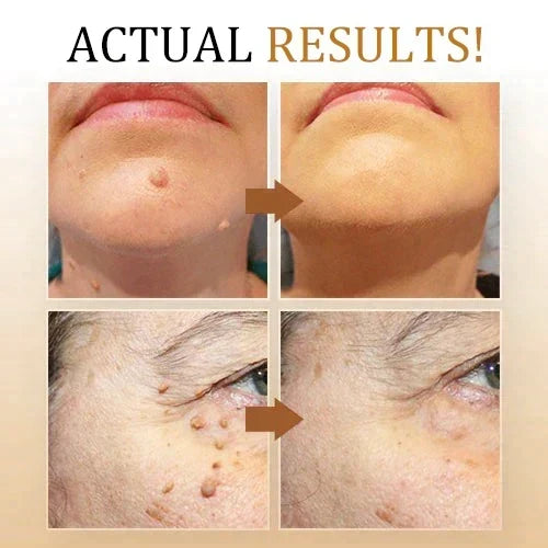 Application ciblée du spray anti-verrues, soin dermocosmétique. Pour une peau saine, sans défauts, et douce.
